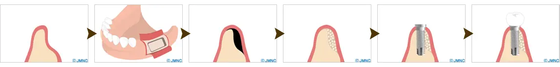 GBR
