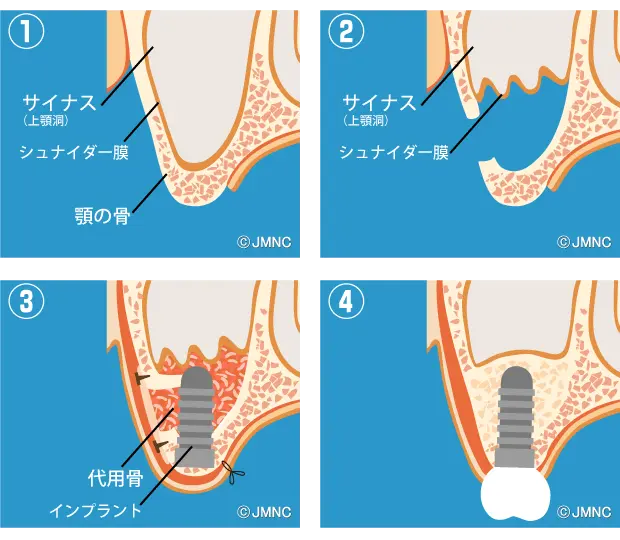サイナスリフト法