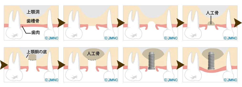 ソケットリフト法