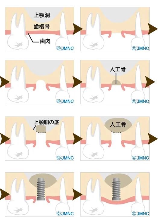 ソケットリフト法