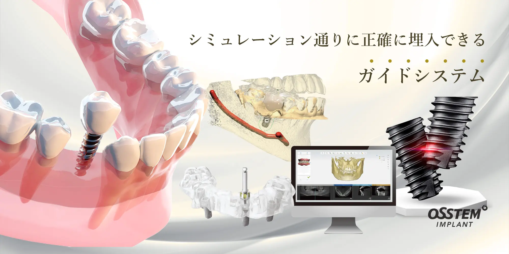 インプラント相談