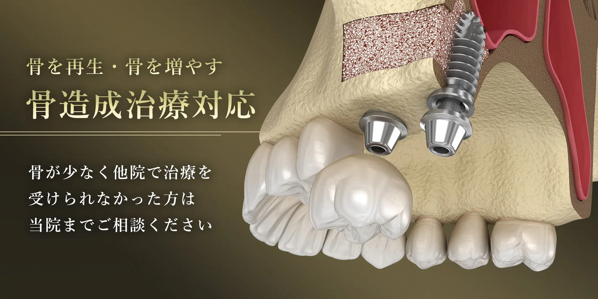 骨造成
